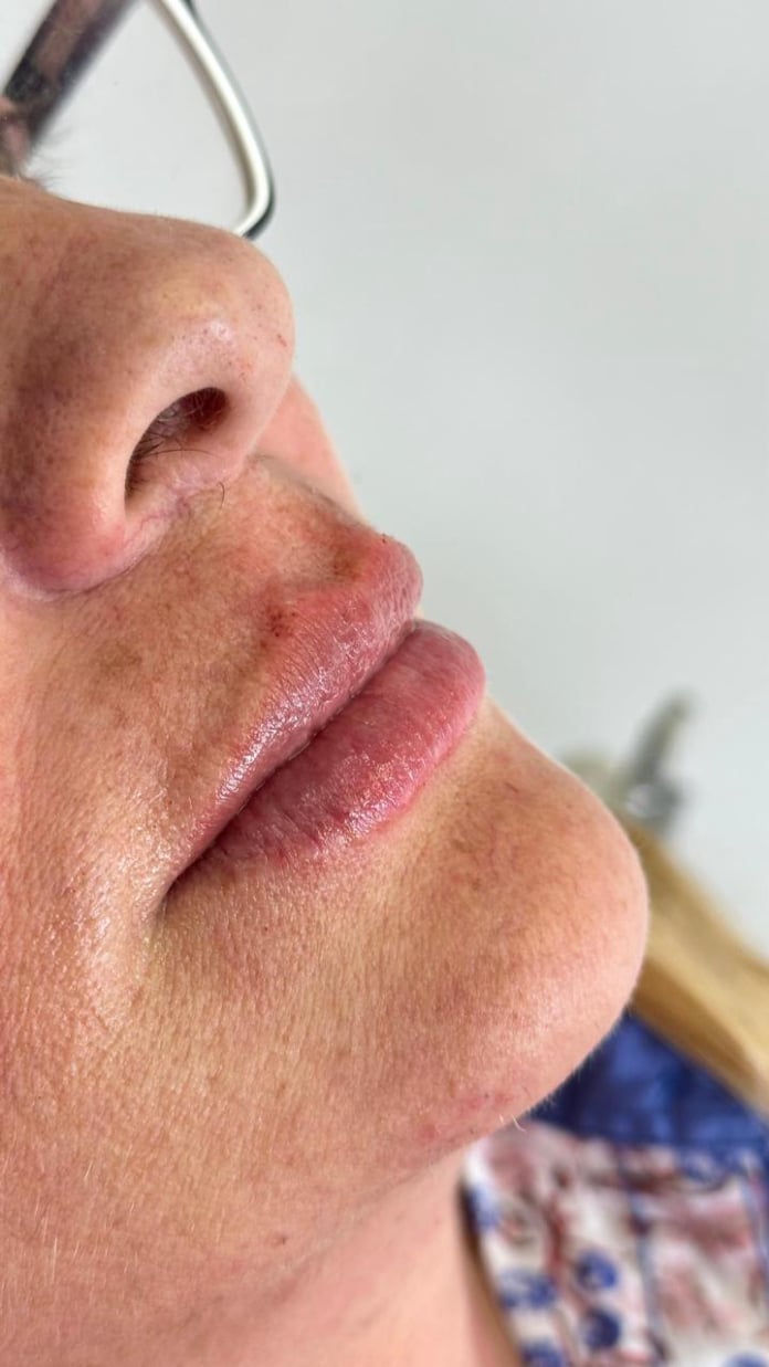 Preenchimento Labial