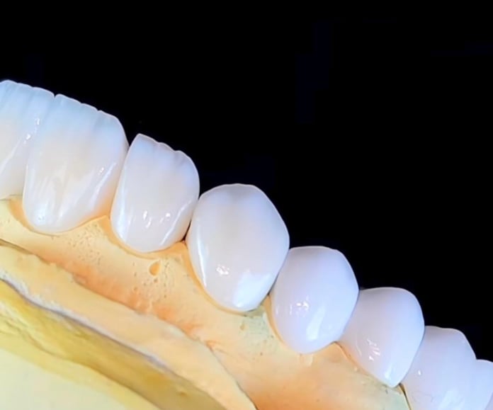 Lentes de Contato Dental